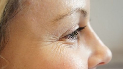 морщины вокруг глаз